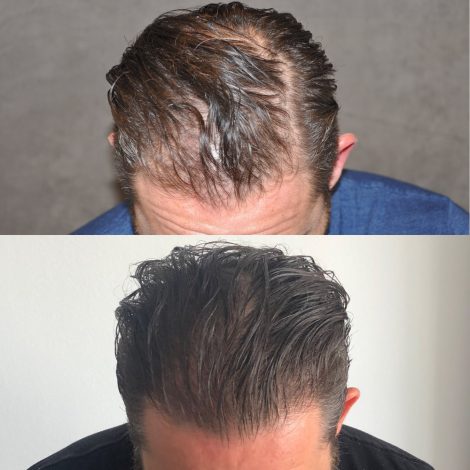 Beverly Hills Center Male Patient Before and After FUE hair transplant and Platelet Rich Plasma