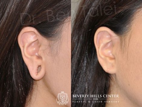 Beverly Hills Center Female Patient Before and After Stretched Ear Lobe Repair Repair