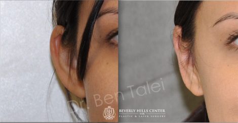 Beverly Hills Center Female Patient Before and After Otoplasty Procedure