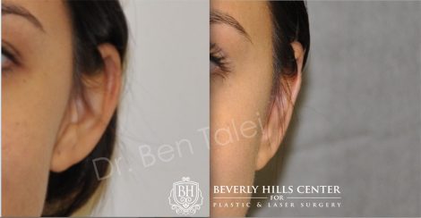 Beverly Hills Center Female Patient Before and After Otoplasty Procedure