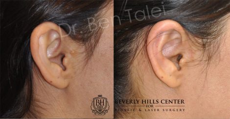 Beverly Hills Center Female Patient Before and After Otoplasty Procedure