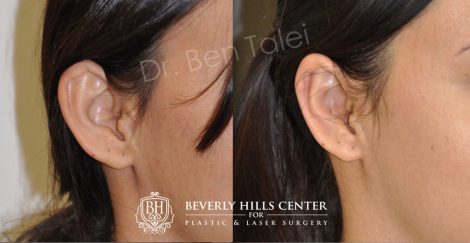 Beverly Hills Center Female Patient Before and After Otoplasty Procedure