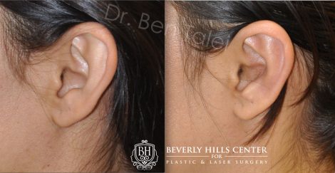 Beverly Hills Center Female Patient Before and After Otoplasty Procedure