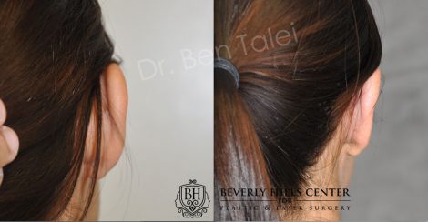 Beverly Hills Center Female Patient Before and After Otoplasty Procedure