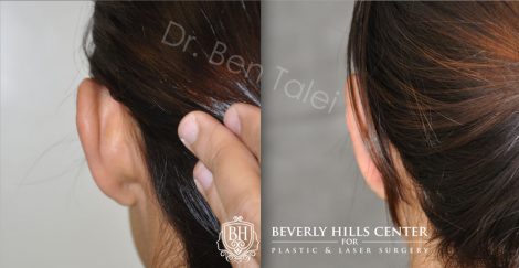 Beverly Hills Center Female Patient Before and After Otoplasty Procedure
