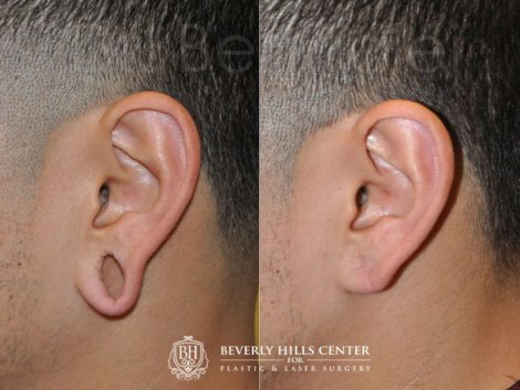 Beverly Hills Male Patient Before and After Gauge Ear Closure Procedure