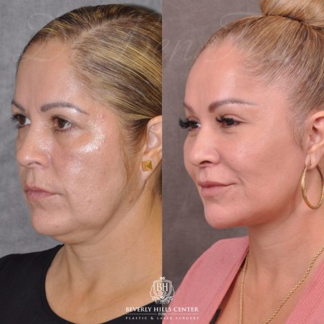Auralyft, Browlift, Modified Upper Lip lift, Upper Bleph & Earlobe Reduction - Left Side