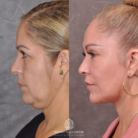 Auralyft, Browlift, Modified Upper Lip lift, Upper Bleph & Earlobe Reduction - Left Side