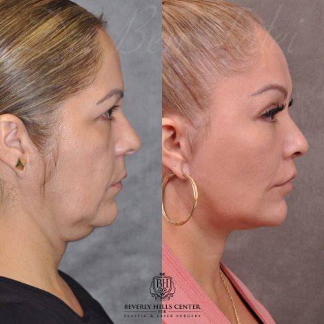 Auralyft, Browlift, Modified Upper Lip lift, Upper Bleph & Earlobe Reduction - Right Side
