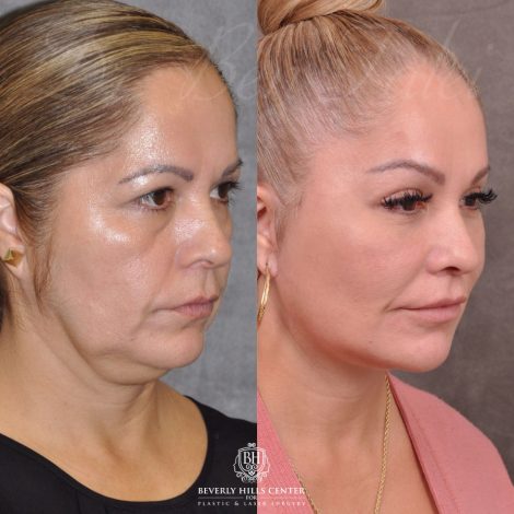 Auralyft, Browlift, Modified Upper Lip lift, Upper Bleph & Earlobe Reduction - Right Side