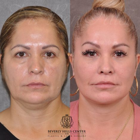 Auralyft, Browlift, Modified Upper Lip lift, Upper Bleph & Earlobe Reduction - Front