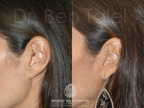Beverly Hills Center Female Patient Before and After Ear Nevus Removal Procedure