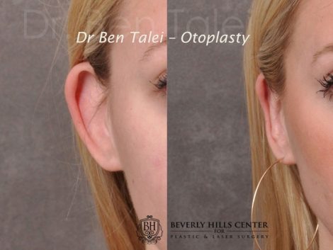 Beverly Hills Center Female Patient Before and After Otoplasty Procedure