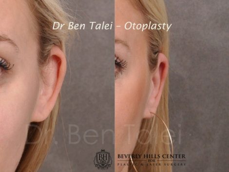 Beverly Hills Center Female Patient Before and After Otoplasty Procedure