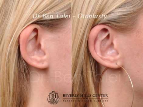 Beverly Hills Center Female Patient Before and After Otoplasty Procedure