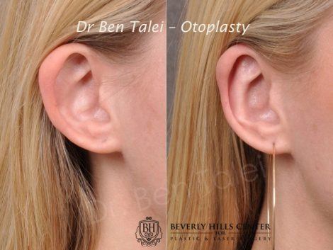 Beverly Hills Center Female Patient Before and After Otoplasty Procedure