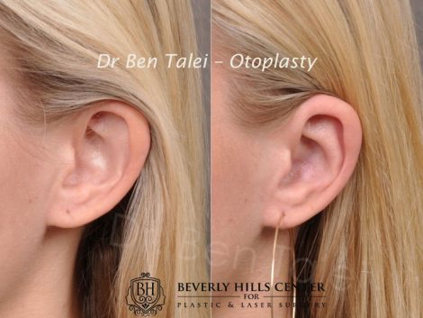 Beverly Hills Center Female Patient Before and After Otoplasty Procedure
