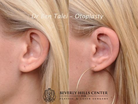 Beverly Hills Center Female Patient Before and After Otoplasty Procedure