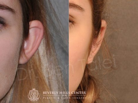 Beverly Hills Center Female Patient Before and After Otoplasty Procedure