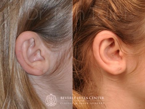 Beverly Hills Center Female Patient Before and After Otoplasty Procedure