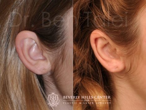 Beverly Hills Center Female Patient Before and After Otoplasty Procedure
