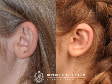 Beverly Hills Center Female Patient Before and After Otoplasty Procedure