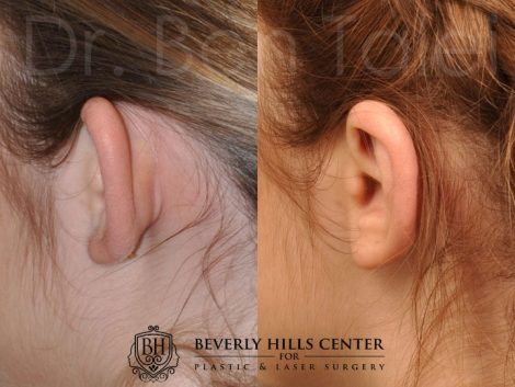 Beverly Hills Center Female Patient Before and After Otoplasty Procedure