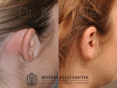 Beverly Hills Center Female Patient Before and After Otoplasty Procedure