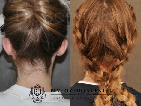Beverly Hills Center Female Patient Before and After Otoplasty Procedure