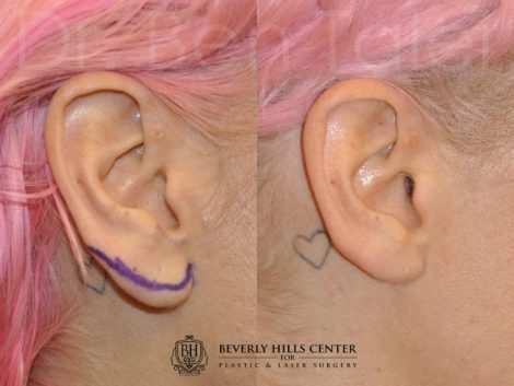Beverly Hills Patient Before and After Ear Lobe Reduction Procedure