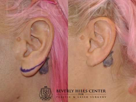 Beverly Hills Patient Before and After Ear Lobe Reduction Procedure