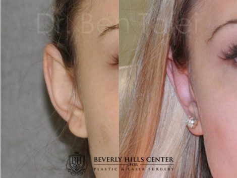 Beverly Hills Center Female Patient Before and After Otoplasty Procedure