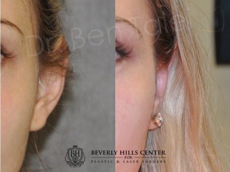 Beverly Hills Center Female Patient Before and After Otoplasty Procedure