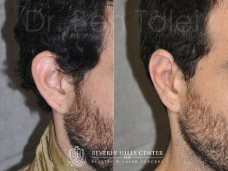 Beverly Hills Male Patient Before and After Otoplasty Procedure