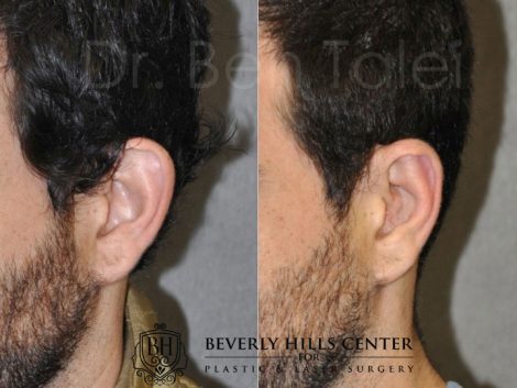 Beverly Hills Male Patient Before and After Otoplasty Procedure