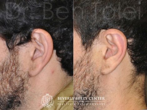 Beverly Hills Male Patient Before and After Otoplasty Procedure