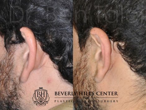Beverly Hills Male Patient Before and After Otoplasty Procedure