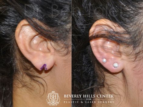 Beverly Hills Center Female Patient Before and After Ear lobe Cleft Repair