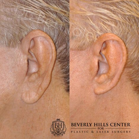 Beverly Hills Patient Before and After Ear Lobe Reduction Procedure