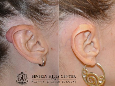 Beverly Hills Center Female Patient Before and After Ear Keloid Removal