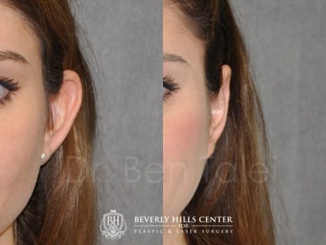 Beverly Hills Center Female Patient Before and After Otoplasty Procedure