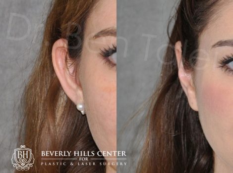Beverly Hills Center Female Patient Before and After Otoplasty Procedure