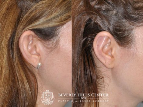 Beverly Hills Center Female Patient Before and After Otoplasty Procedure