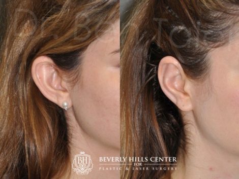 Beverly Hills Center Female Patient Before and After Otoplasty Procedure