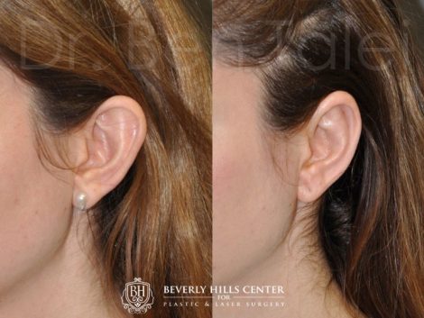 Beverly Hills Center Female Patient Before and After Otoplasty Procedure