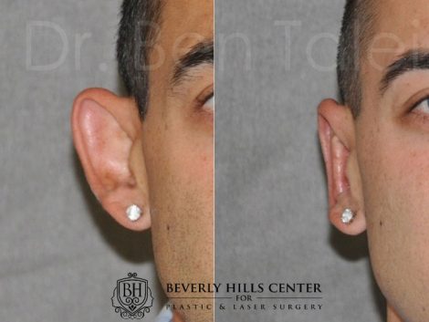Beverly Hills Male Patient Before and After Otoplasty Procedure
