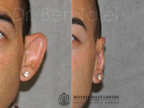 Beverly Hills Male Patient Before and After Otoplasty Procedure