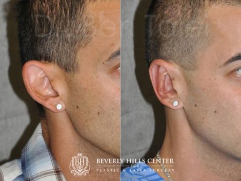 Beverly Hills Male Patient Before and After Otoplasty Procedure