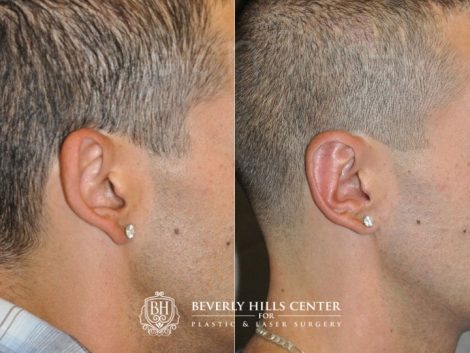 Beverly Hills Male Patient Before and After Otoplasty Procedure