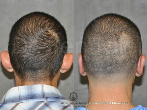 Beverly Hills Male Patient Before and After Otoplasty Procedure